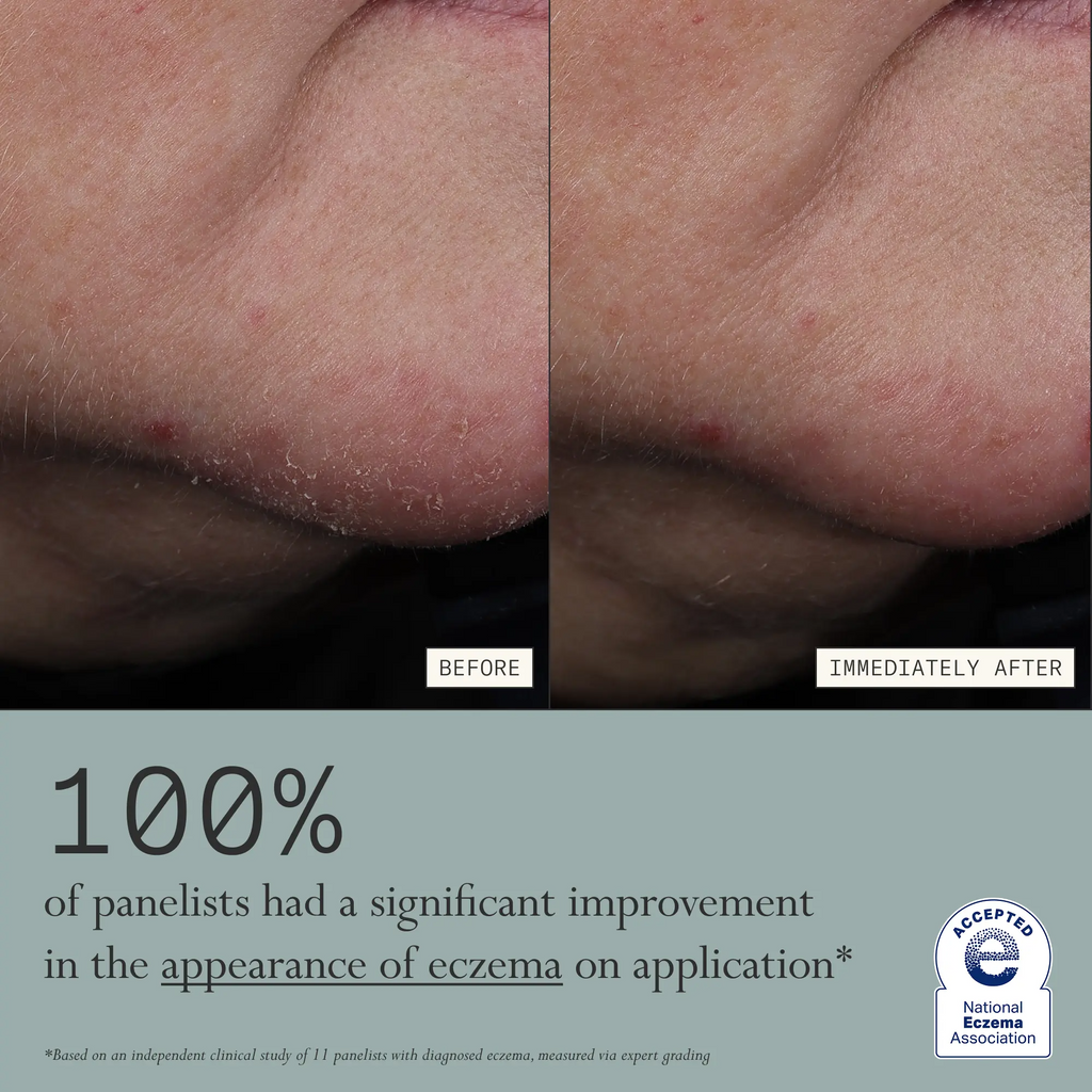 Skin Mercy Recovery Cream – 1% Colloidal Oatmeal Moisturizer for Sensitive, Dry & Irritated Skin | Clinically Proven