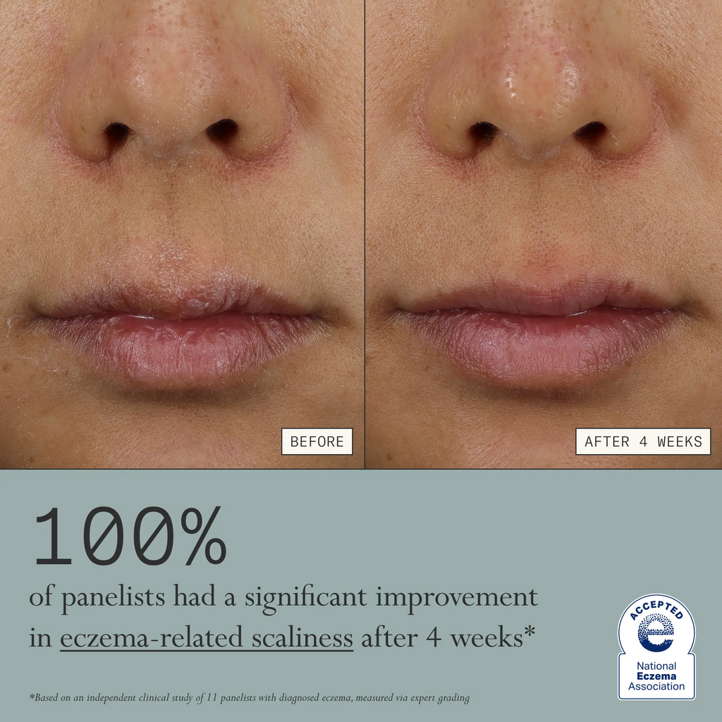Skin Mercy Recovery Cream – 1% Colloidal Oatmeal Moisturizer for Sensitive, Dry & Irritated Skin | Clinically Proven