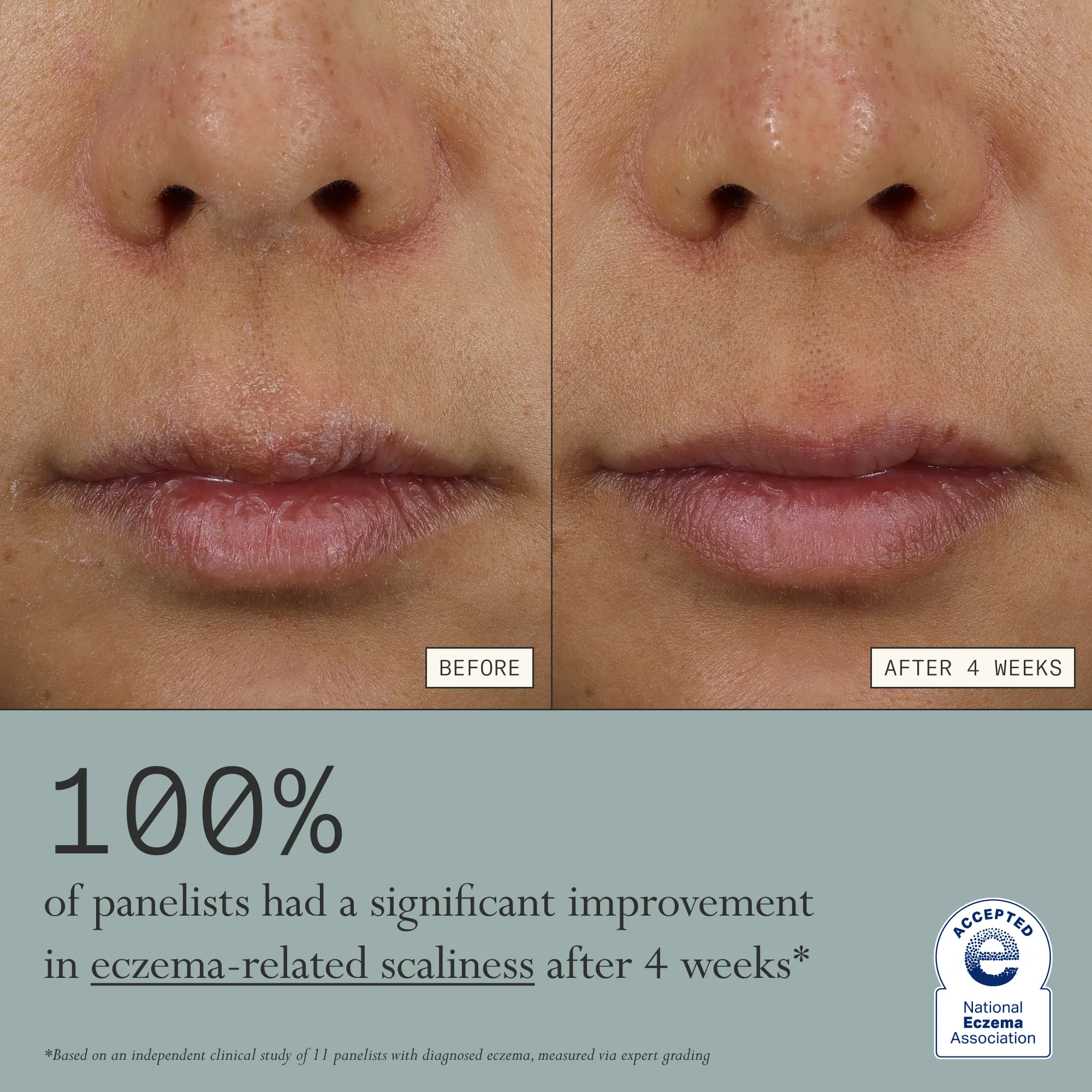 Skin Mercy Recovery Cream – 1% Colloidal Oatmeal Moisturizer for Sensitive, Dry & Irritated Skin | Clinically Proven